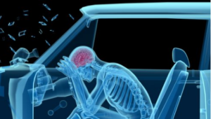 Developing Epilepsy After a Car Accident